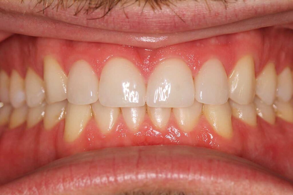 When veneers can reshape a smile plan